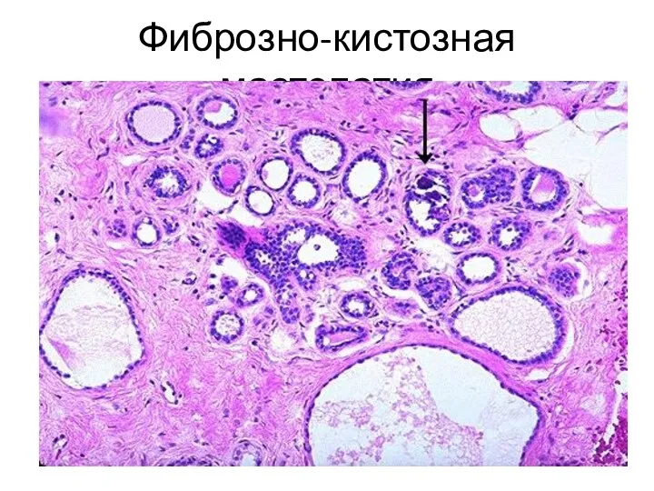 Фиброзно-кистозная мастопатия