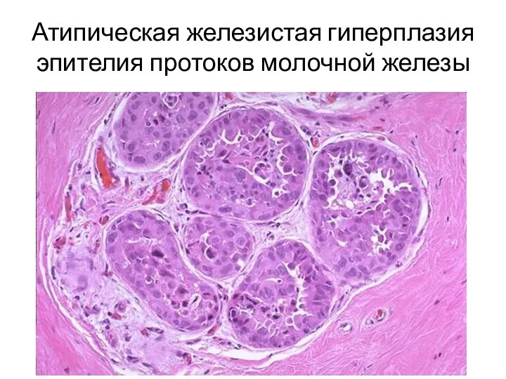 Атипическая железистая гиперплазия эпителия протоков молочной железы