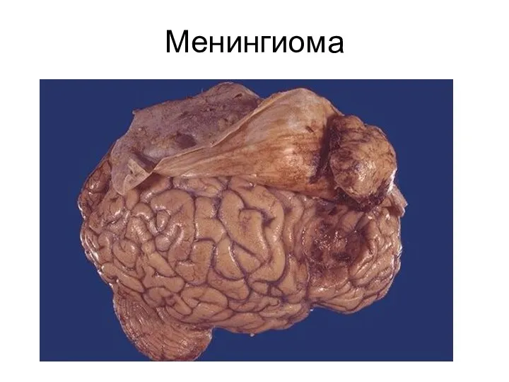 Менингиома