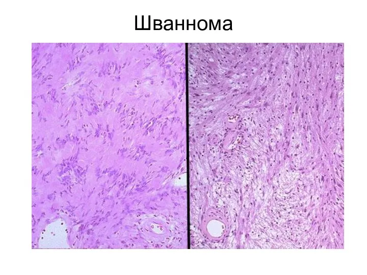 Шваннома