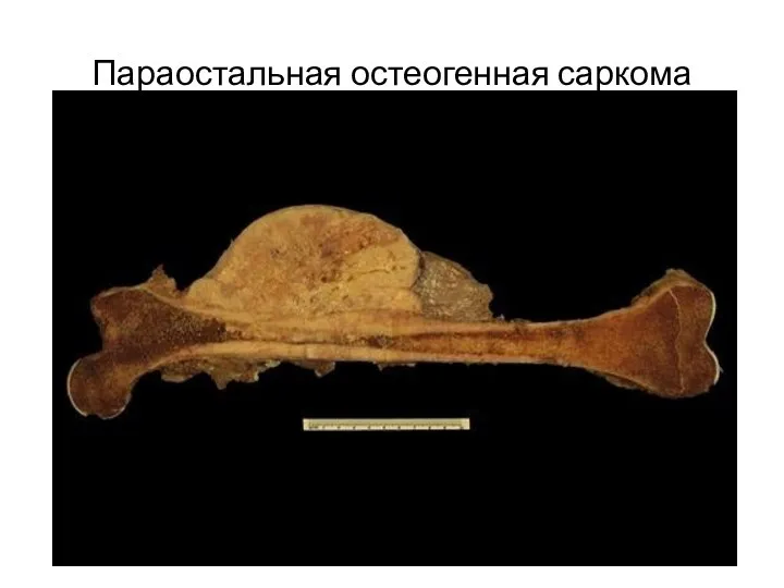 Параостальная остеогенная саркома