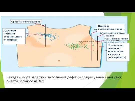 Каждая минута задержки выполнения дефибрилляции увеличивает риск смерти больного на 10%