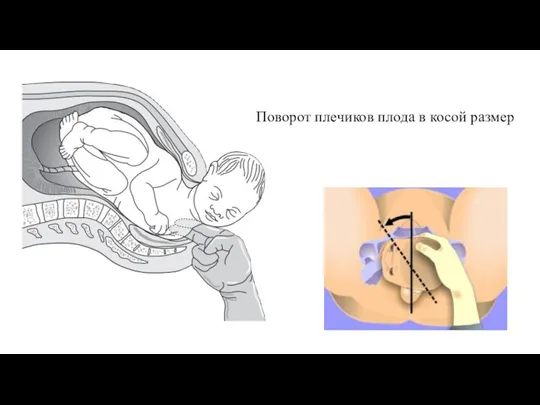 Поворот плечиков плода в косой размер