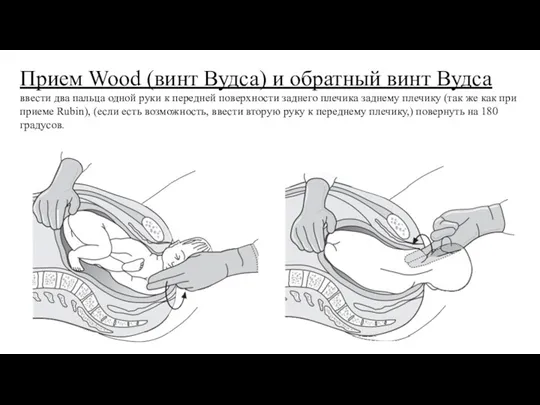 Прием Wood (винт Вудса) и обратный винт Вудса ввести два