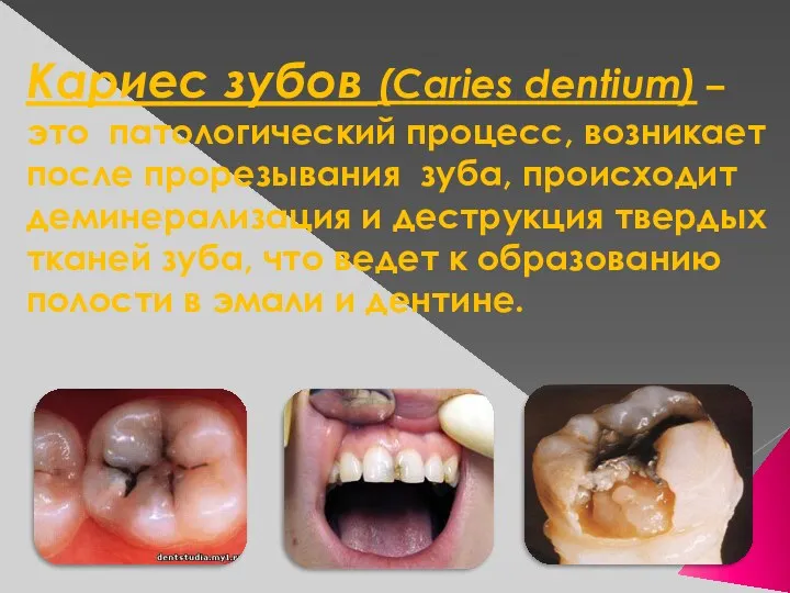 Кариес зубов (Caries dentium) – это патологический процесс, возникает после