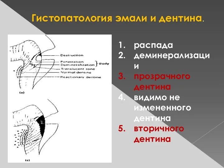 Гистопатология эмали и дентина. распада деминерализации прозрачного дентина видимо не измененного дентина вторичного дентина