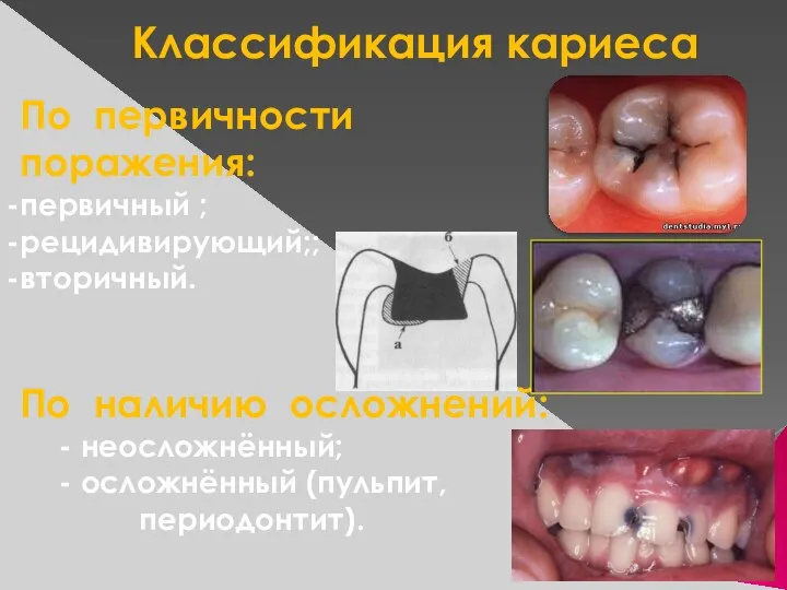 Классификация кариеса По наличию осложнений: - неосложнённый; - осложнённый (пульпит,