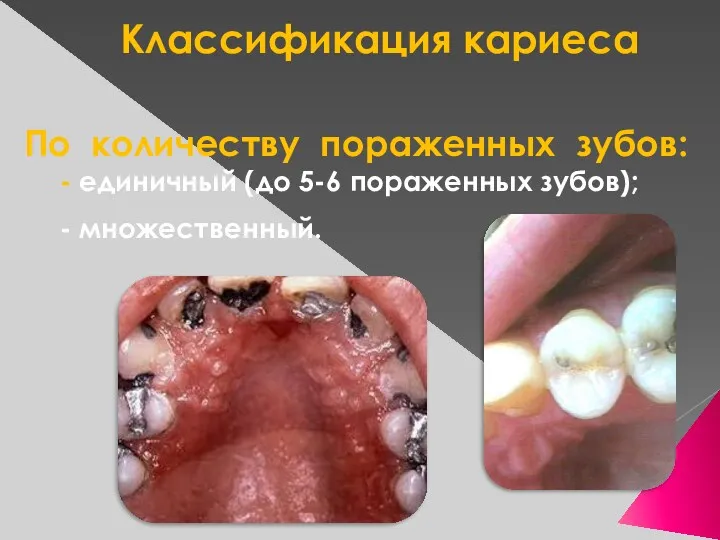 Классификация кариеса По количеству пораженных зубов: - единичный (до 5-6 пораженных зубов); - множественный.