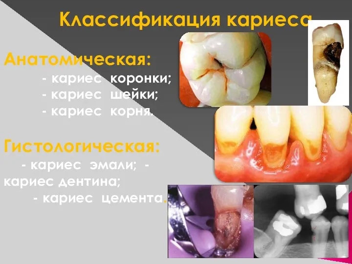 Классификация кариеса Анатомическая: - кариес коронки; - кариес шейки; -