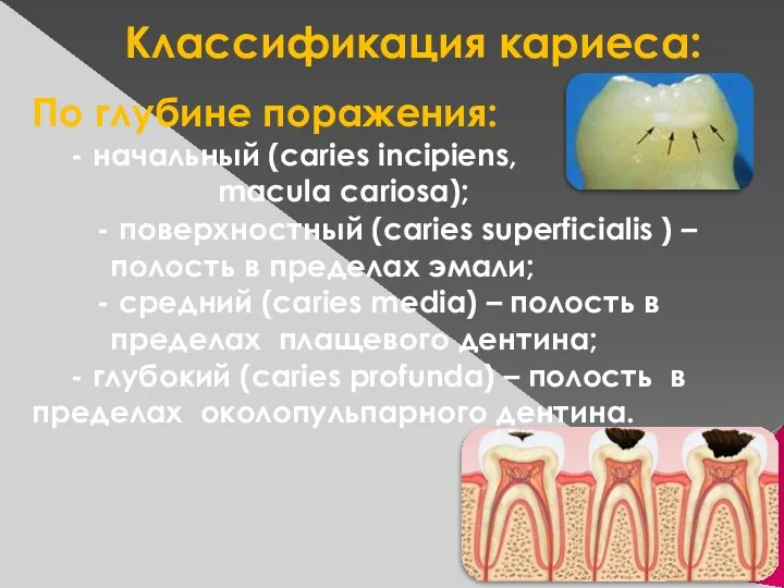 Классификация кариеса: По глубине поражения: - начальный (caries incipiens, macula