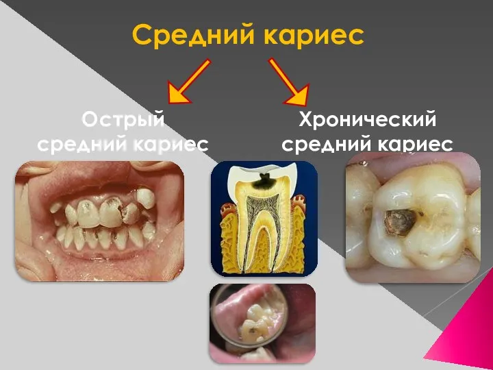 Средний кариес Острый средний кариес Хронический средний кариес