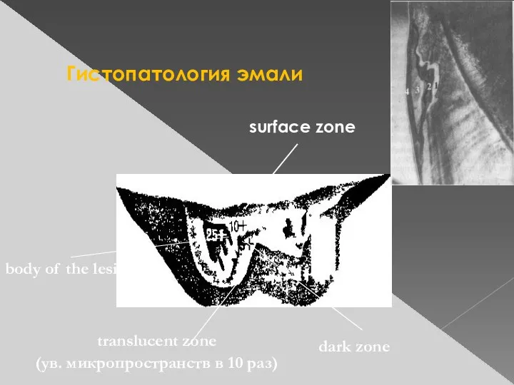 Гистопатология эмали surface zone dark zone body of the lesion