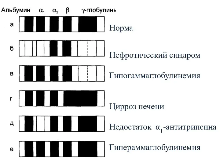Норма Нефротический синдром Гипогаммаглобулинемия Цирроз печени Недостаток α1-антитрипсина Гипераммаглобулинемия