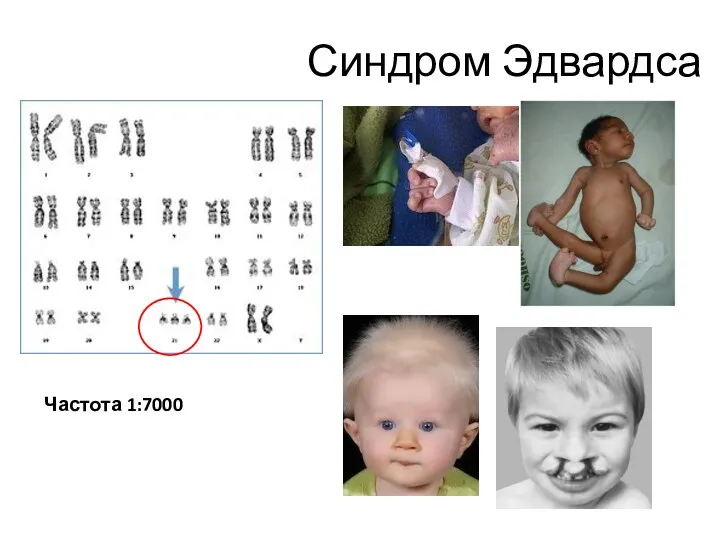 Синдром Эдвардса Частота 1:7000