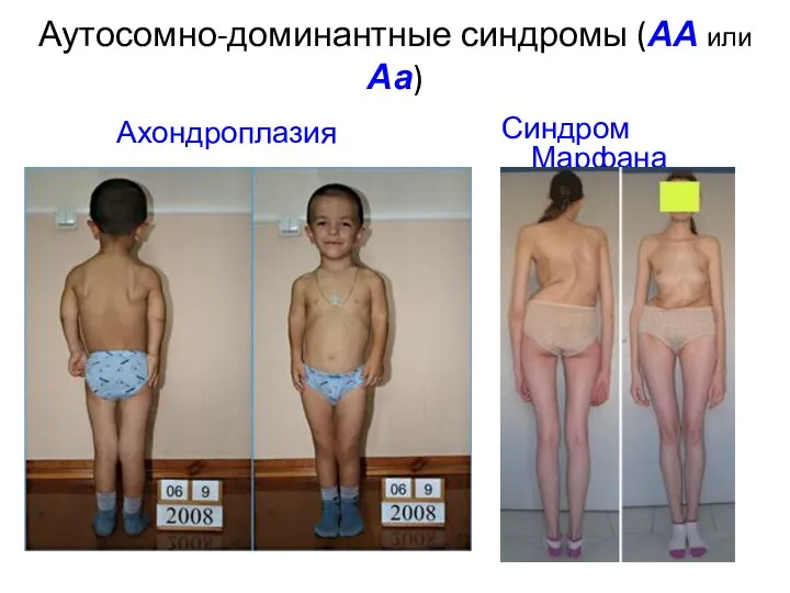 Аутосомно-доминантные синдромы (АА или Аа) Синдром Марфана Ахондроплазия