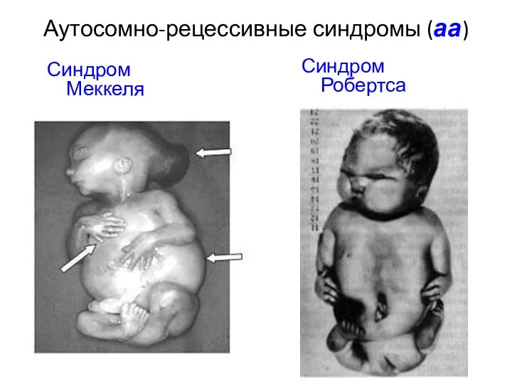 Аутосомно-рецессивные синдромы (аа) Синдром Меккеля Синдром Робертса