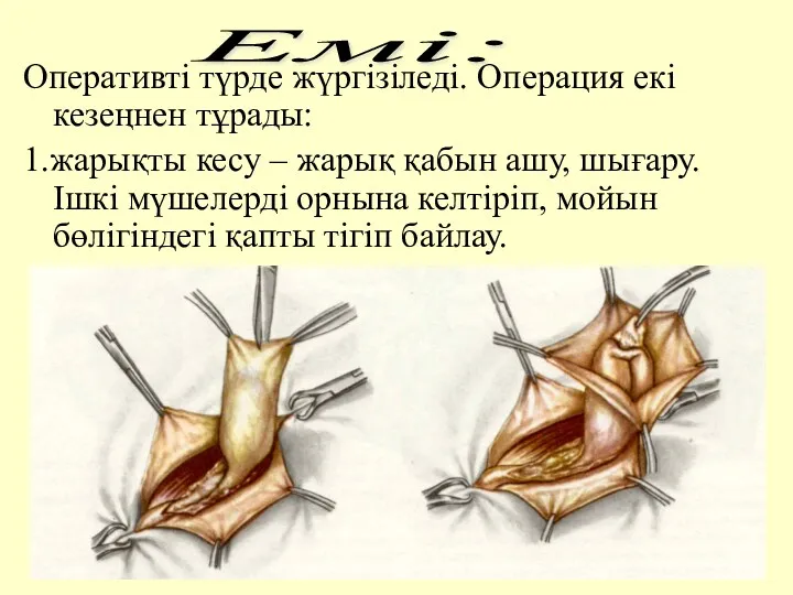 Оперативтi түрде жүргiзiледi. Операция екi кезеңнен тұрады: 1.жарықты кесу –