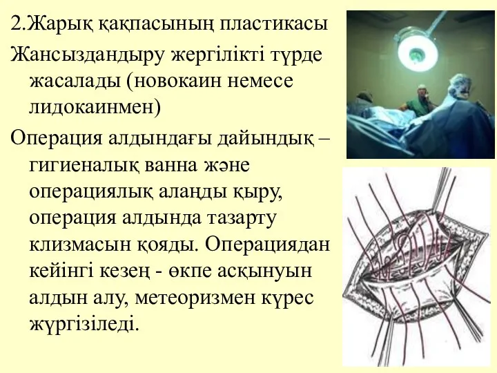 2.Жарық қақпасының пластикасы Жансыздандыру жергiлiктi түрде жасалады (новокаин немесе лидокаинмен)