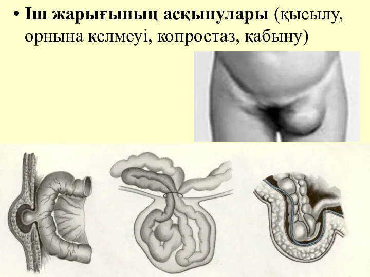 Iш жарығының асқынулары (қысылу, орнына келмеуi, копростаз, қабыну)