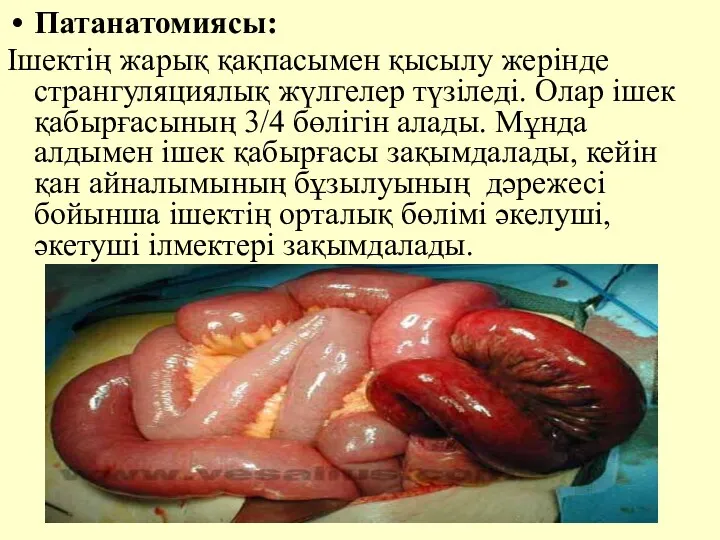 Патанатомиясы: Iшектiң жарық қақпасымен қысылу жерiнде странгуляциялық жүлгелер түзiледi. Олар