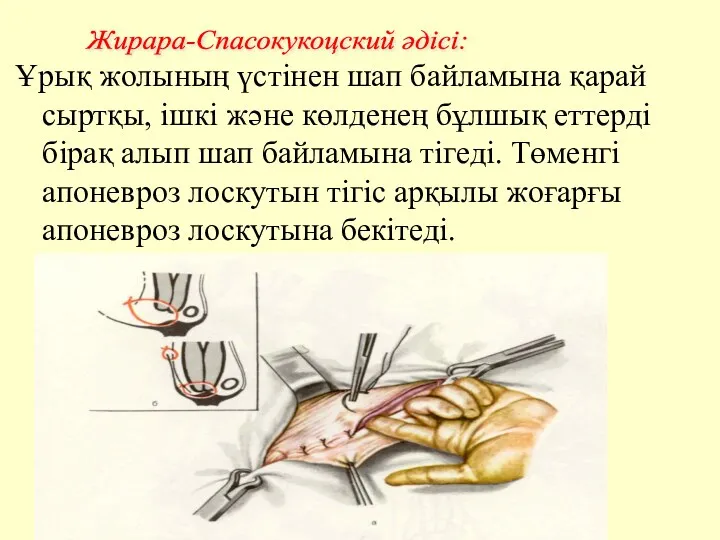 Ұрық жолының үстінен шап байламына қарай сыртқы, ішкі және көлденең