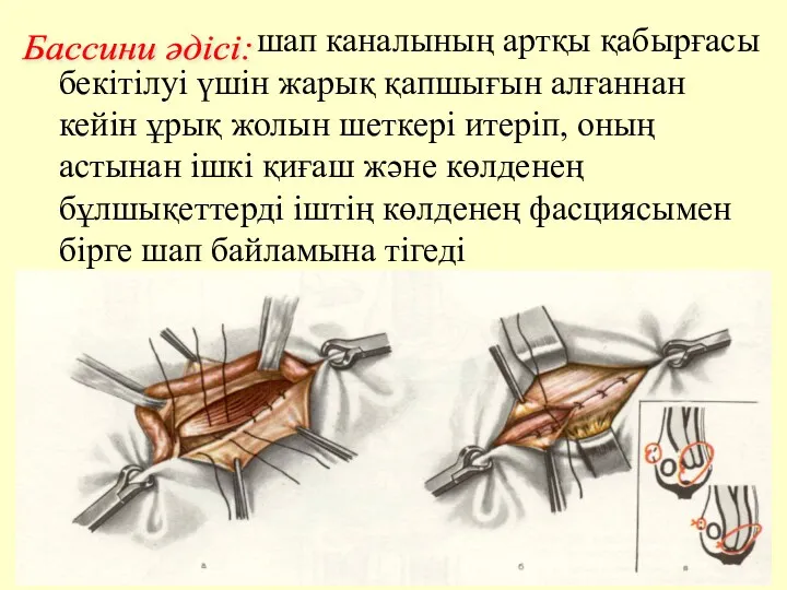 шап каналының артқы қабырғасы бекітілуі үшін жарық қапшығын алғаннан кейін