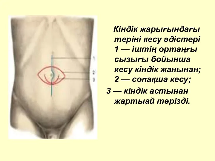 Кіндік жарығындағы теріні кесу әдістері 1 — іштің ортаңғы сызығы