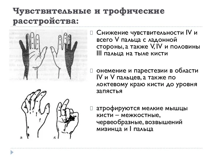 Чувствительные и трофические расстройства: Снижение чувствительности IV и всего V