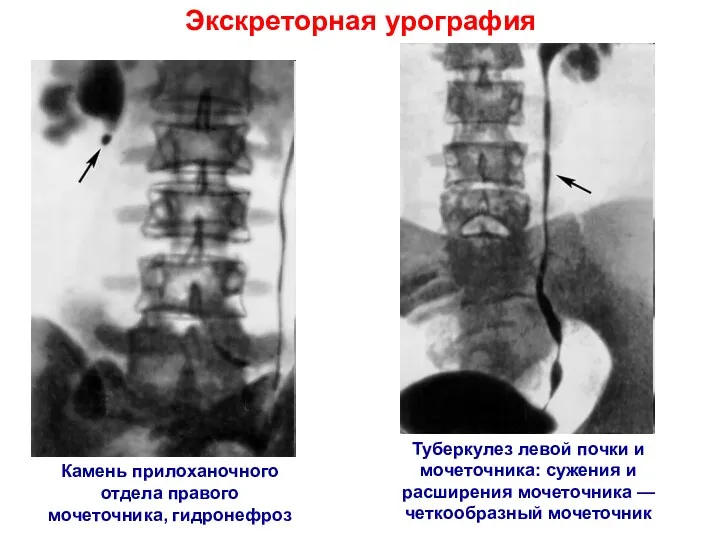 Экскреторная урография Камень прилоханочного отдела правого мочеточника, гидронефроз Туберкулез левой почки и мочеточника: