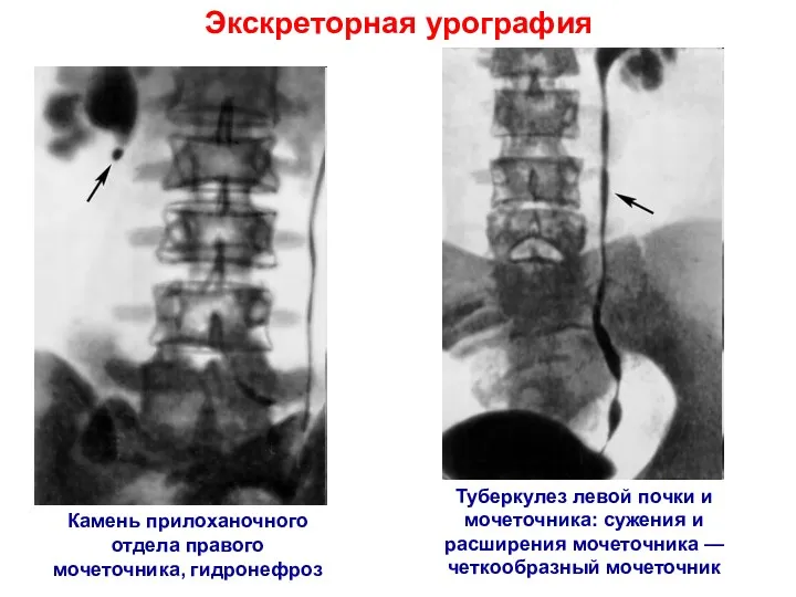 Экскреторная урография Камень прилоханочного отдела правого мочеточника, гидронефроз Туберкулез левой