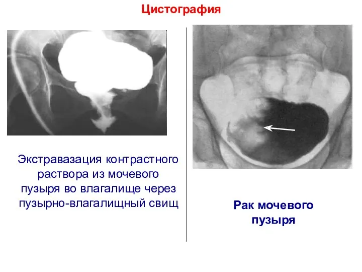 Цистография Экстравазация контрастного раствора из мочевого пузыря во влагалище через пузырно-влагалищный свищ Рак мочевого пузыря