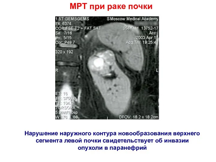 МРТ при раке почки Нарушение наружного контура новообразования верхнего сегмента левой почки свидетельствует