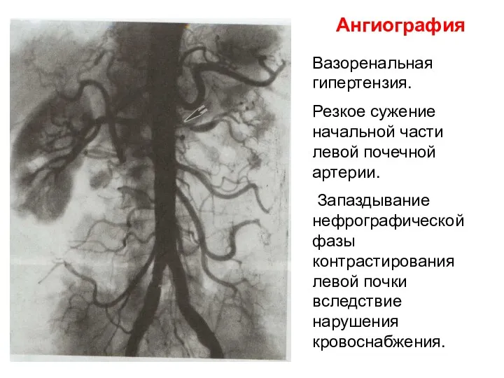 Ангиография Вазоренальная гипертензия. Резкое сужение начальной части левой почечной артерии. Запаздывание нефрографической фазы