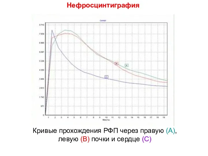 Нефросцинтиграфия Кривые прохождения РФП через правую (А), левую (В) почки и сердце (С)