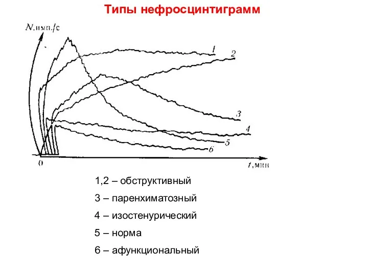 Типы нефросцинтиграмм 1,2 – обструктивный 3 – паренхиматозный 4 – изостенурический 5 –