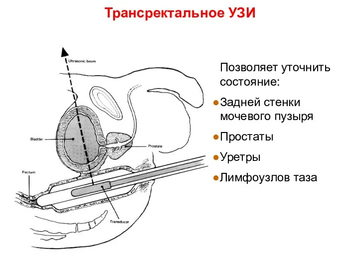 Трансректальное УЗИ Позволяет уточнить состояние: Задней стенки мочевого пузыря Простаты Уретры Лимфоузлов таза