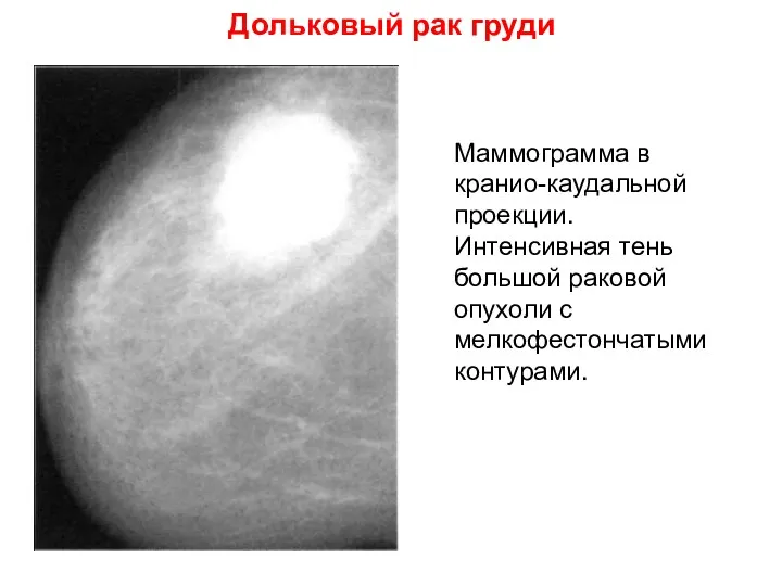 Дольковый рак груди Маммограмма в кранио-каудальной проекции. Интенсивная тень большой раковой опухоли с мелкофестончатыми контурами.