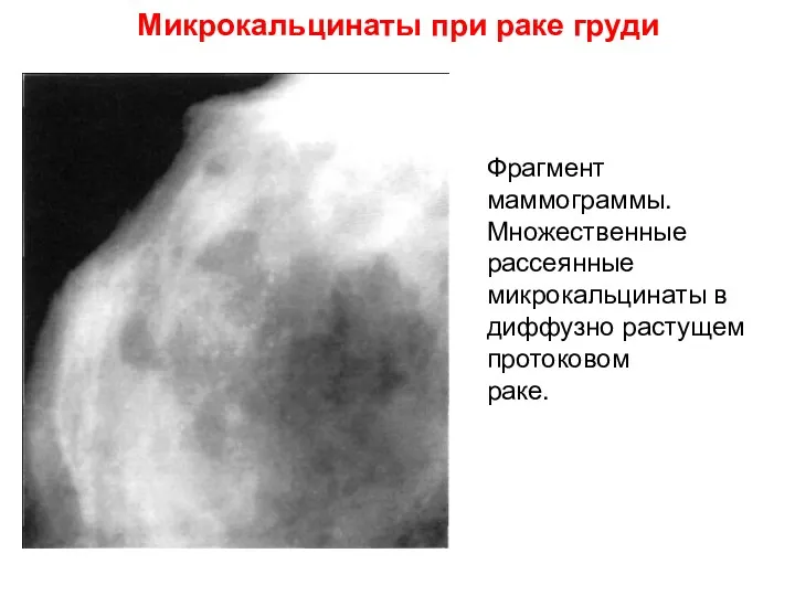 Микрокальцинаты при раке груди Фрагмент маммограммы. Множественные рассеянные микрокальцинаты в диффузно растущем протоковом раке.