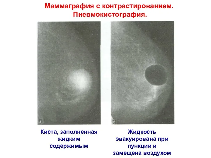 Киста, заполненная жидким содержимым Жидкость эвакуирована при пункции и замещена воздухом Маммаграфия с контрастированием. Пневмокистография.
