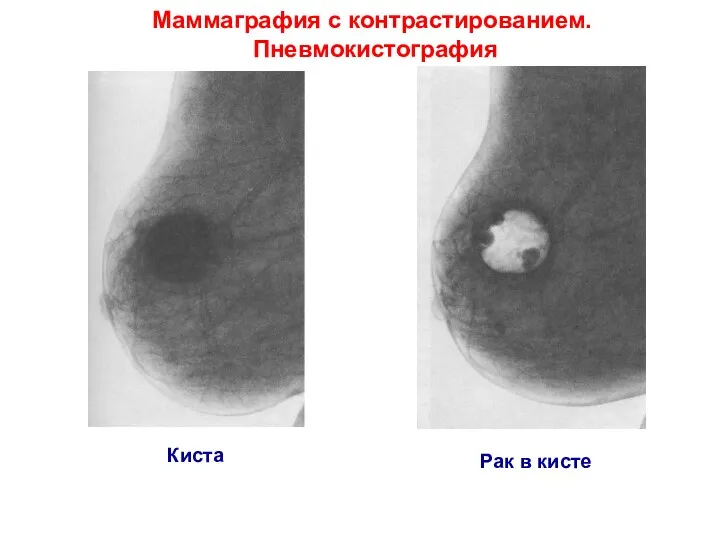 Киста Рак в кисте Маммаграфия с контрастированием. Пневмокистография