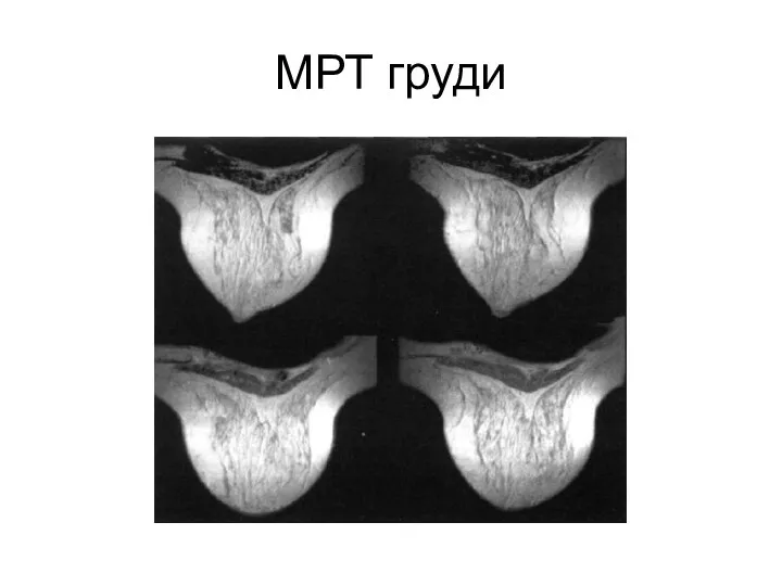 МРТ груди