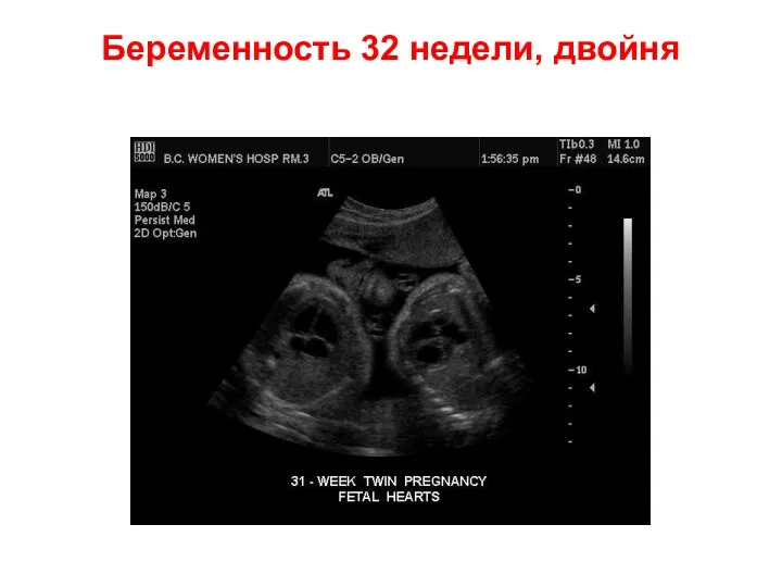 Беременность 32 недели, двойня