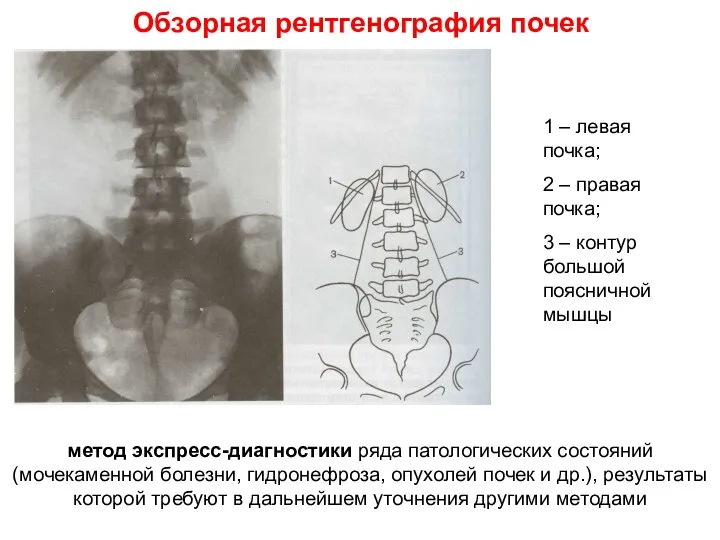 Обзорная рентгенография почек 1 – левая почка; 2 – правая