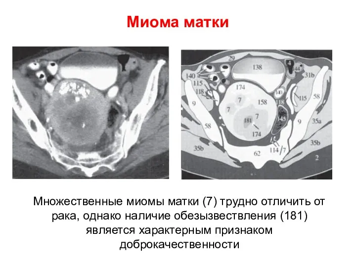 Миома матки Множественные миомы матки (7) трудно отличить от рака, однако наличие обезызвествления