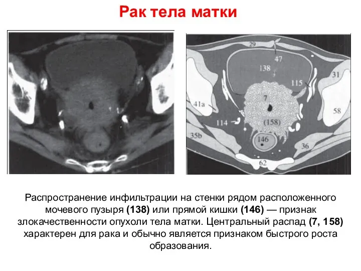 Рак тела матки Распространение инфильтрации на стенки рядом расположенного мочевого