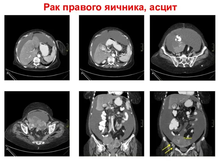 Рак правого яичника, асцит