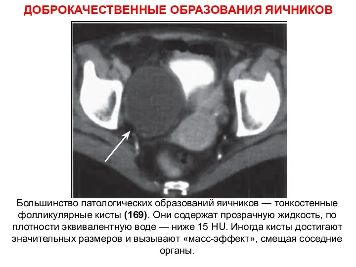 ДОБРОКАЧЕСТВЕННЫЕ ОБРАЗОВАНИЯ ЯИЧНИКОВ Большинство патологических образований яичников — тонкостенные фолликулярные кисты (169). Они