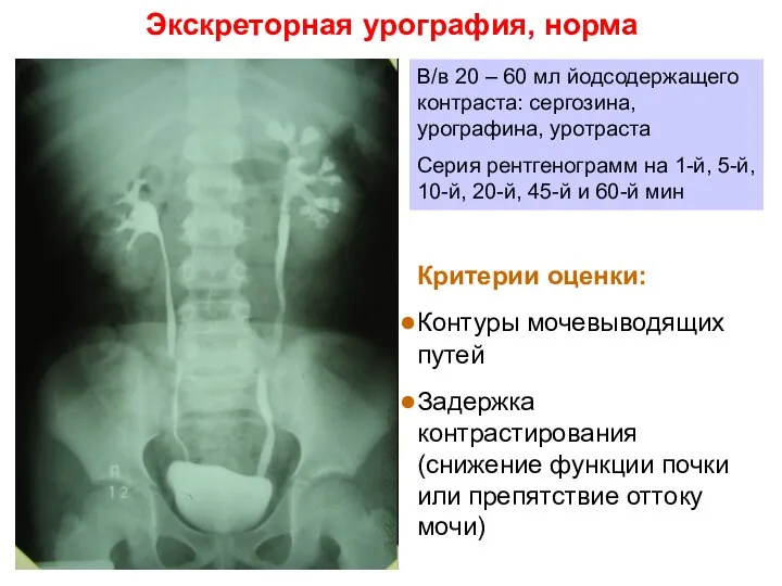 Экскреторная урография, норма В/в 20 – 60 мл йодсодержащего контраста: