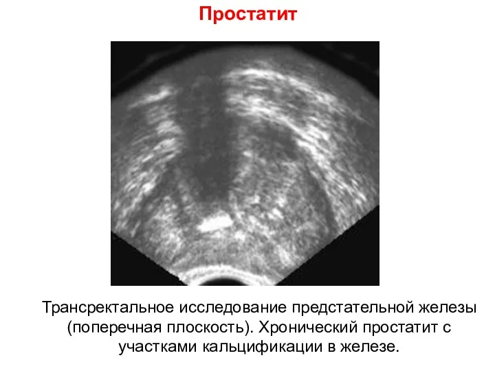 Простатит Трансректальное исследование предстательной железы (поперечная плоскость). Хронический простатит с участками кальцификации в железе.