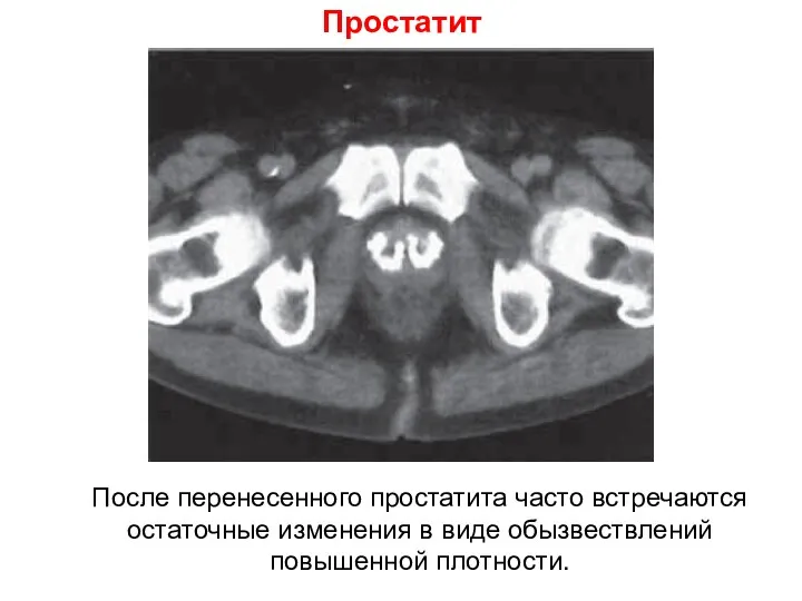 Простатит После перенесенного простатита часто встречаются остаточные изменения в виде обызвествлений повышенной плотности.